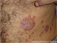 Psoriasis-Before